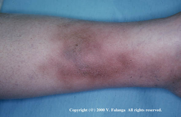 19. Acute lipodermatosclerosis